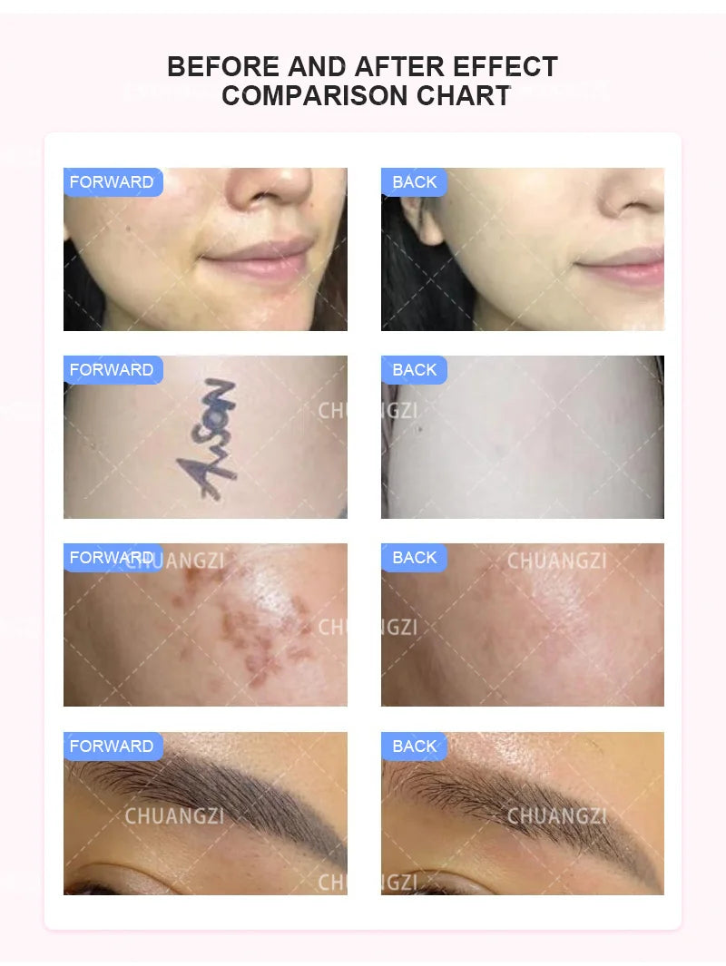 MYOSLIM 3 In 1 IPL Laser Hair Removal Machine System