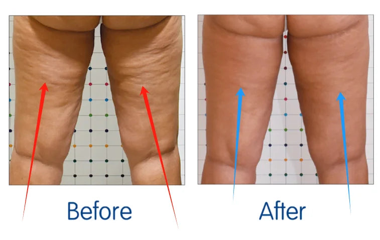 EMSZERO Coolwave Body Shaping Machine For Slimming And Fat Burn