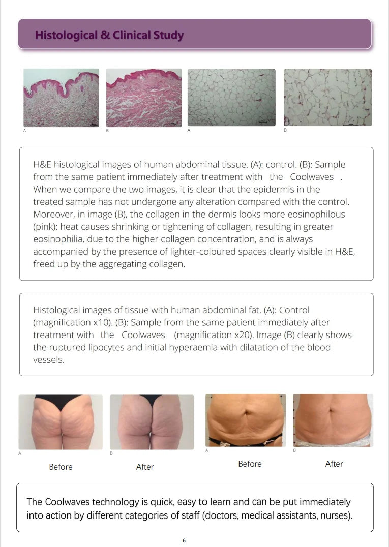 EMSZERO Coolwave Body Shaping Machine For Slimming And Fat Burn