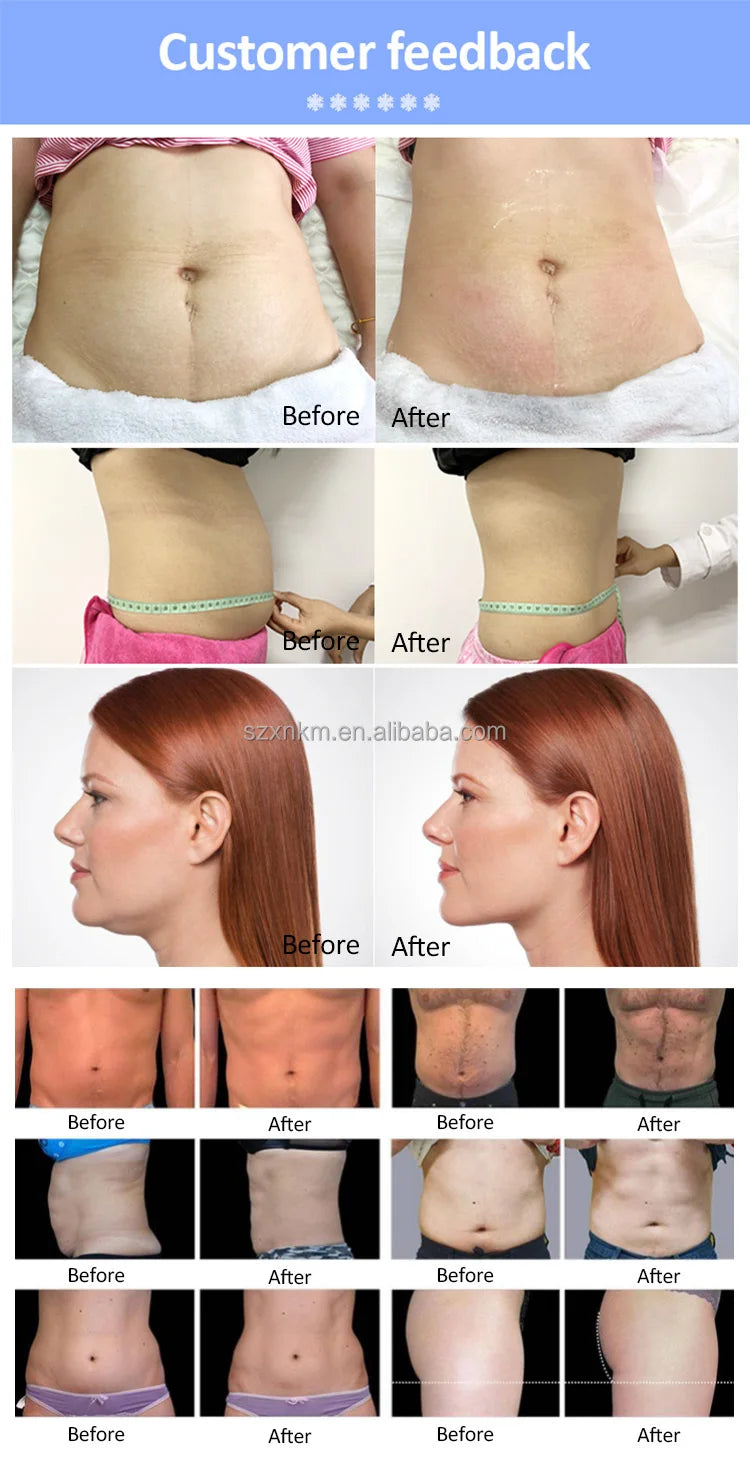 MYOSLIM 360 Fat Freezing Machine With Cavitation RF Lipo Laser