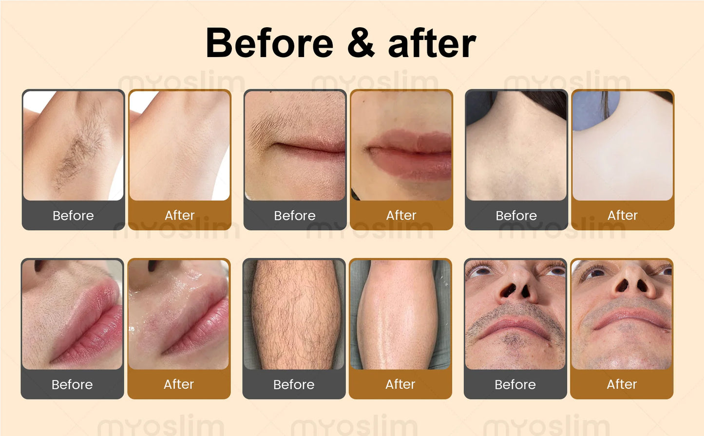 MYOSLIM Diode Laser Hair Removal Device Soprano 4 Wave 755 940 1064 808nm CE