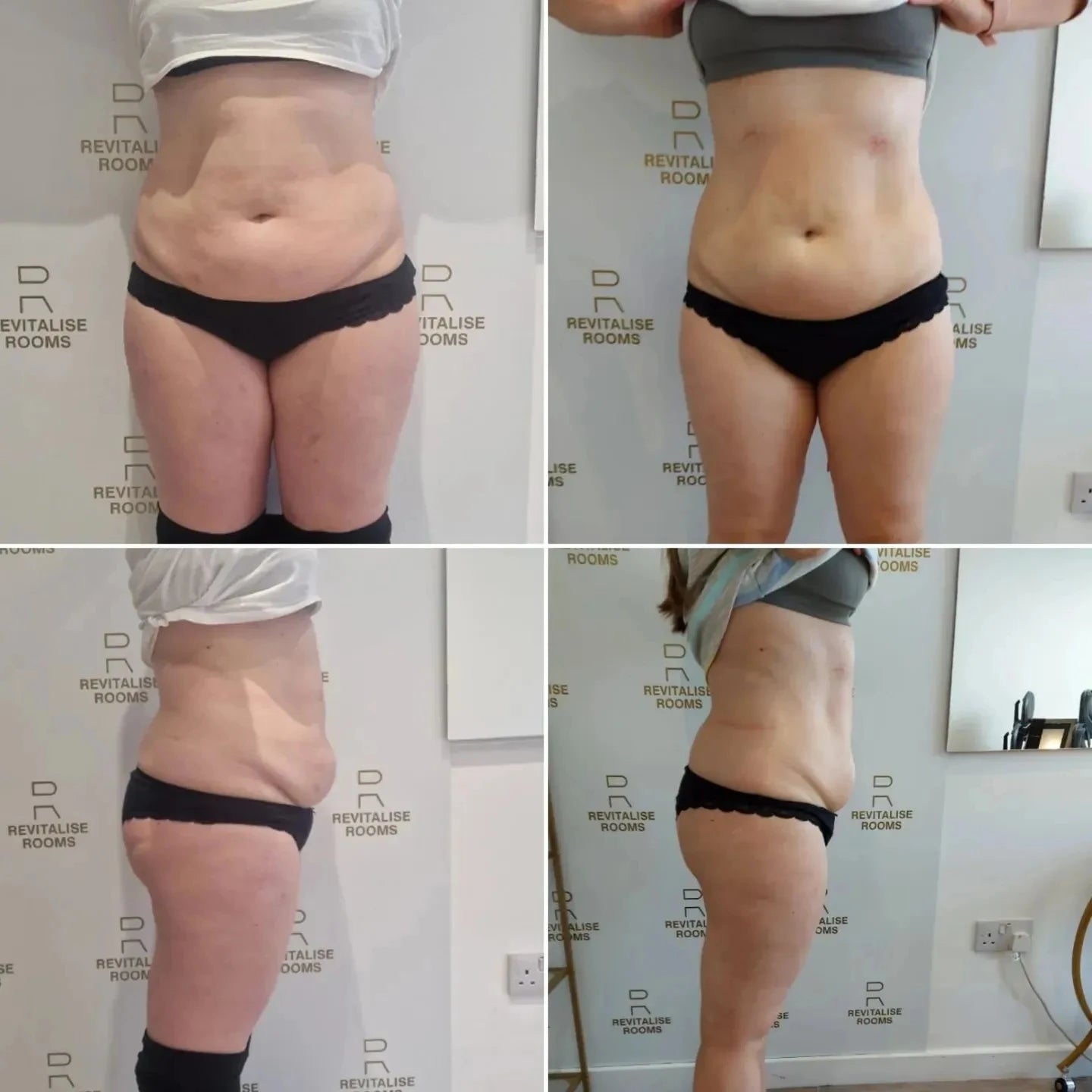 Myoslim EMS RF Machine Neo 15Tesla 6500W Sculpt Fat Reduction
