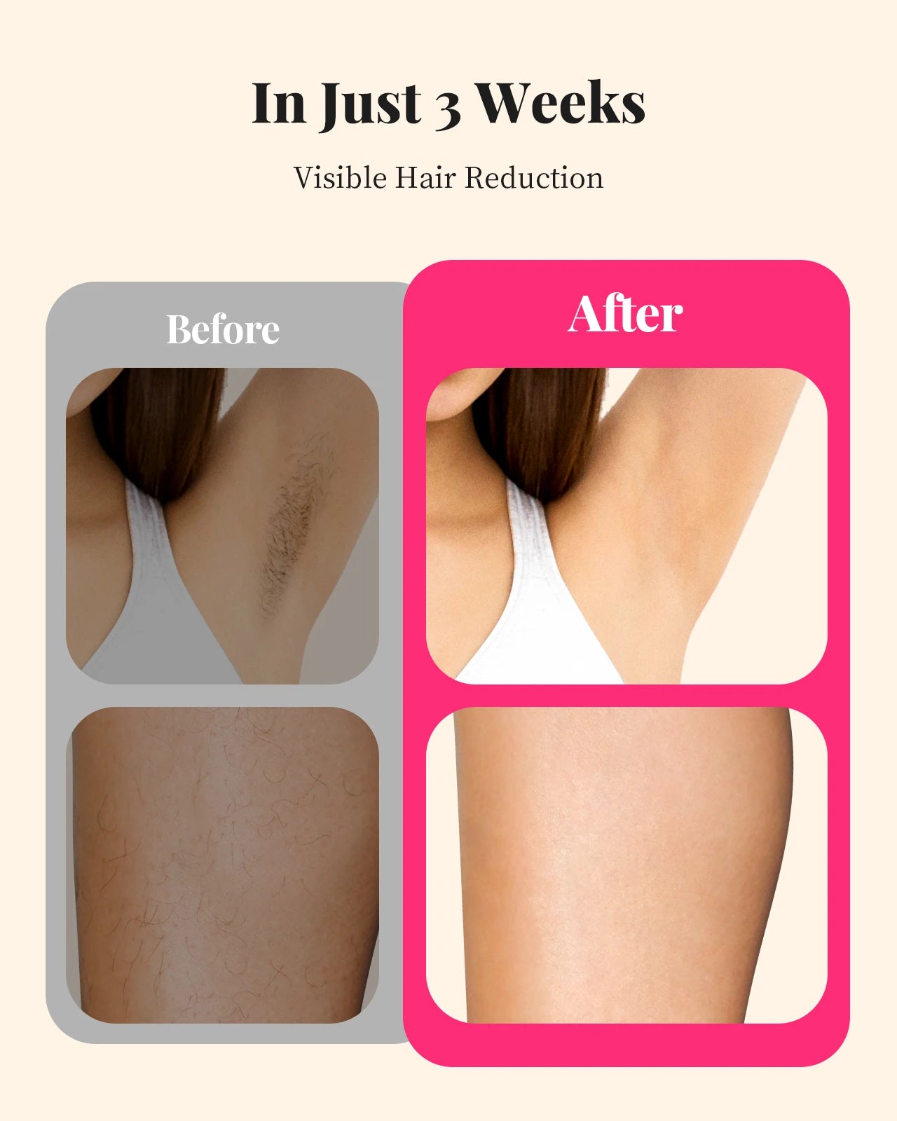 Totmizby IPL Laser Hair Removal Epilator For Body And Face