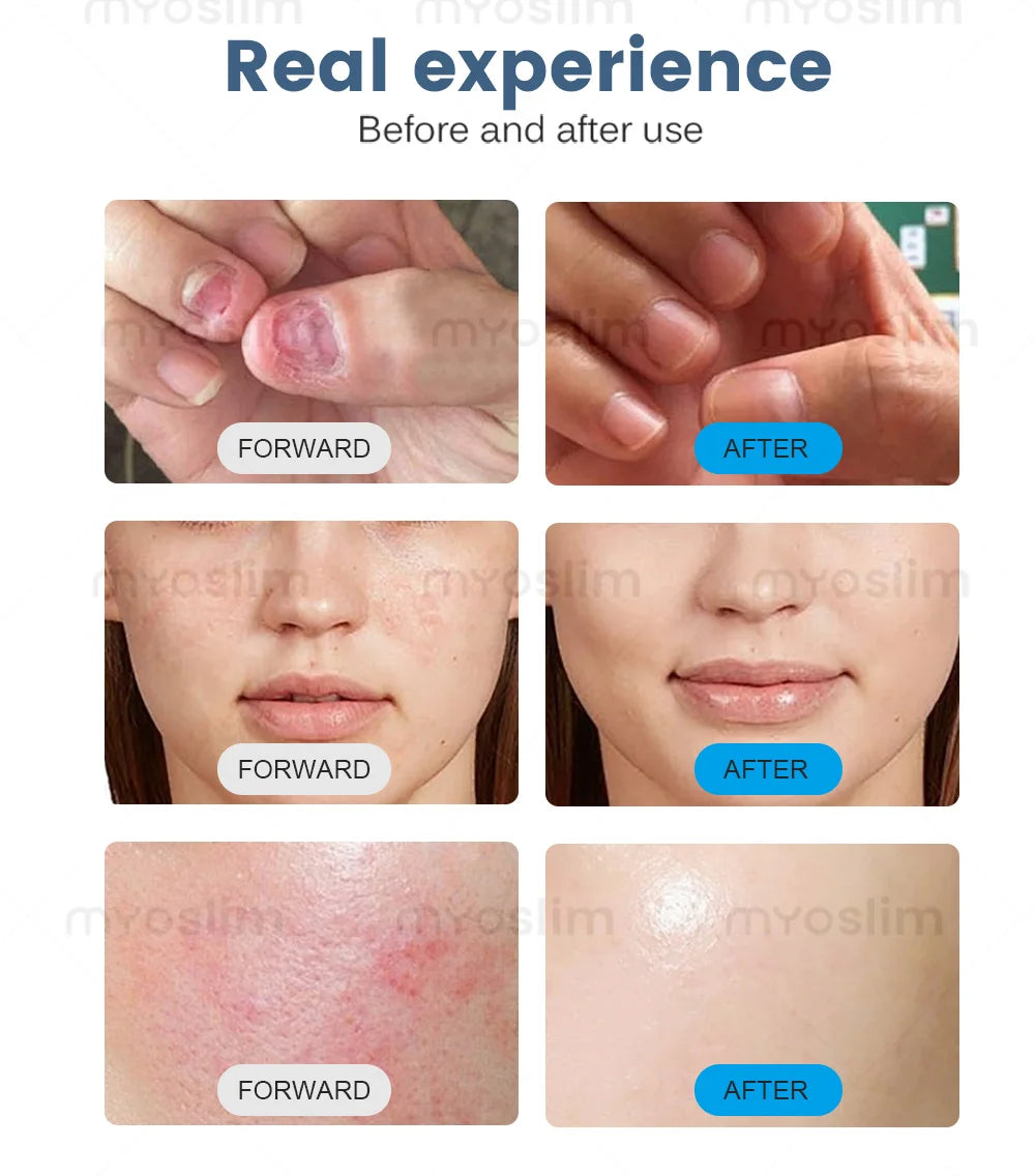 5 In 1 980nm Diode Laser Vascular Removal Nail Fungus