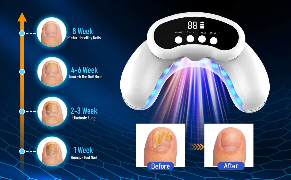 KTS 45W Nail Fungus Treatment Device With 30 LEDs 470nm 905nm
