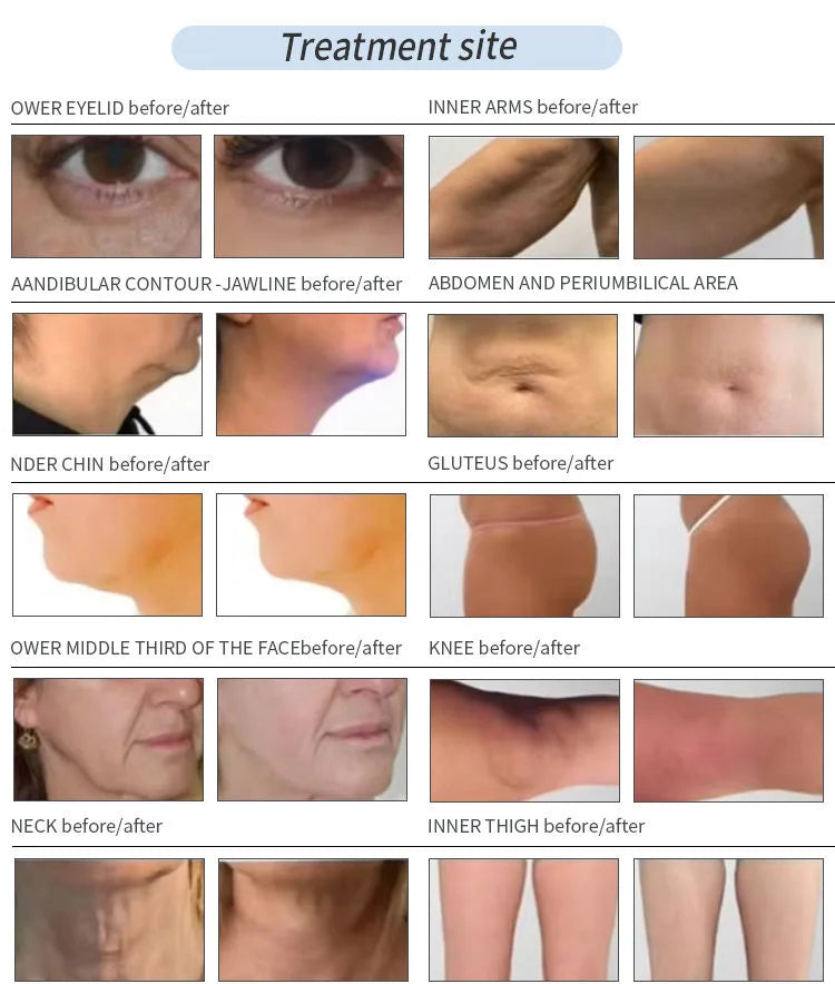 MYOSLIM Diode Laser Lipolysis System For Body Slimming
